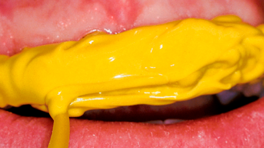 Нанесение Хонигум Лайт - этап 3